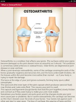 Osteoarthritis Help and Home Remedies android App screenshot 6